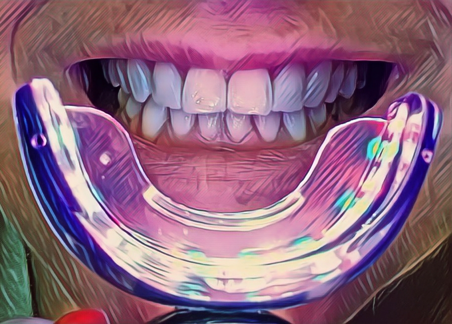Phonebleaching – hit czy kit?